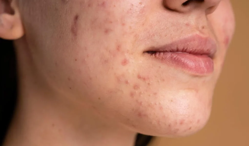 Acne Questions