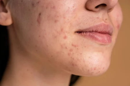 Acne Questions